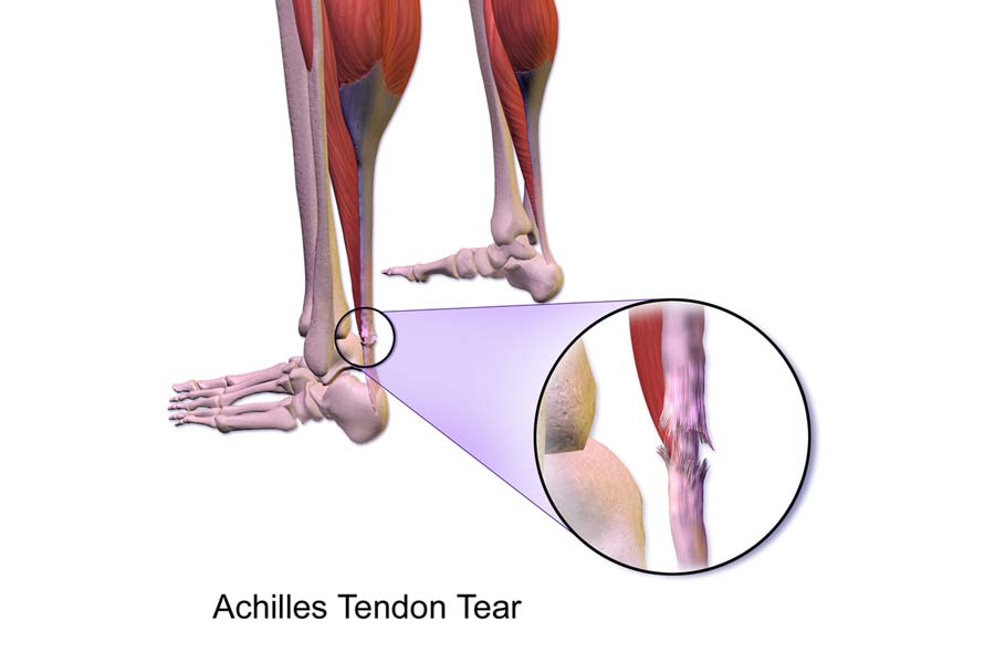 Gân gót chân (Achilles) có thể bị đứt hoặc viêm gây đau nhức